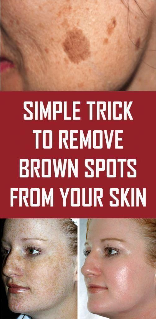 get-rid-of-the-brown-marks-on-your-skin-with-this-simple-trick