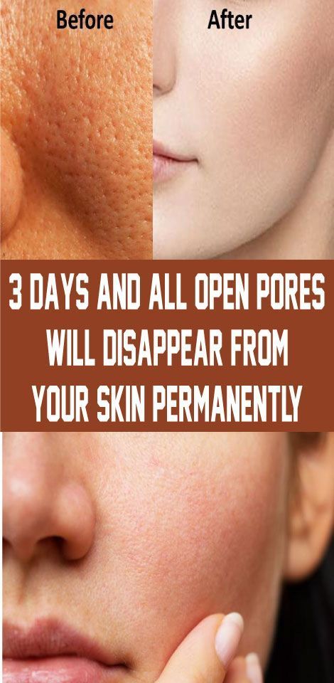 3 Days And All Open Pores Will Disappear From Your Skin Permanently 