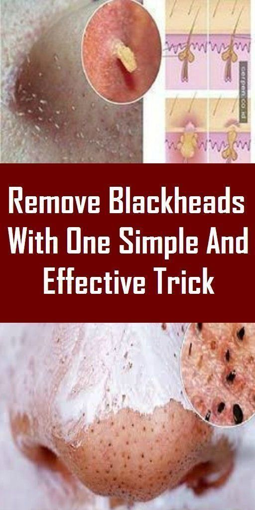 Remove Blackheads With One Simple And Effective Trick